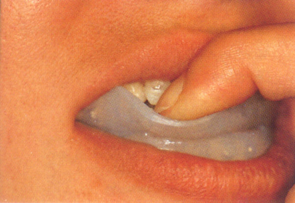 Elastoligner 4 300dpi.JPG (108275 Byte)