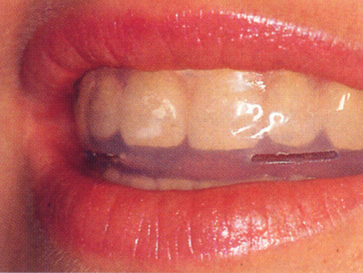 Elastoligner 5 300dpi.JPG (119791 Byte)