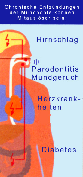 Parodontitis allgemein.JPG (67410 Byte)